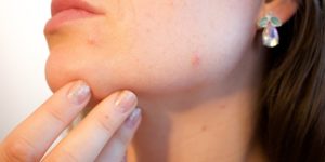 Pimples Home Remedy in Hindi