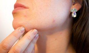 Pimples Home Remedy in Hindi